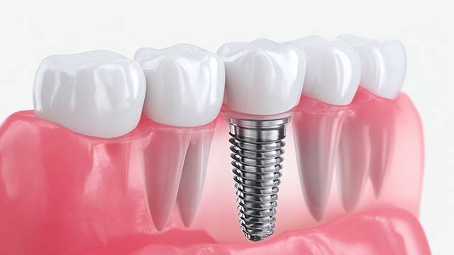 임플란트는 시술 자체보다 관리가 더 중요하다｜출처: 게티이미지뱅크