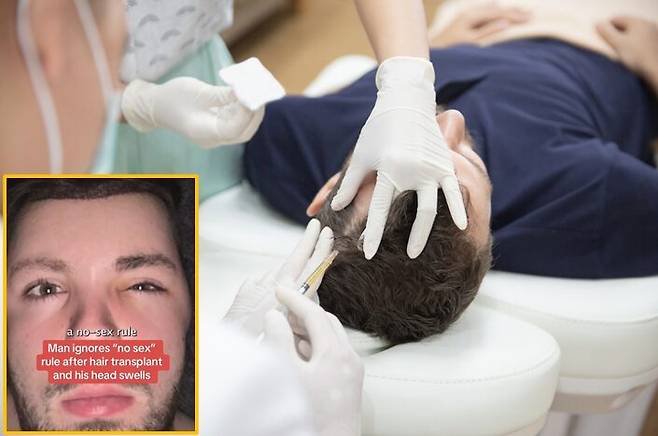 모발이식 후 성관계를 포함한 고강도 활동을 자제하라는 의료진의 조언을 무시한 20대 남성이 얼굴이 풍선처럼 부어 오르는 부작용을 경험한 일을 공유했다. [배경 사진=게티이미지뱅크 / 왼쪽 하단 사진=SNS]