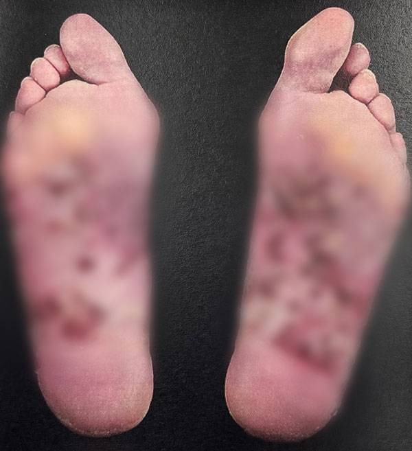 중증 손발바닥농포증 환자의 발 사진./사진=UpToDate