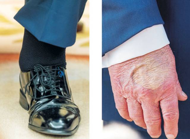 도널드 트럼프 미국 대통령의 왼쪽 발이 부어오른 모습(왼쪽 사진)과 오른쪽 손등의 멍자국. AP 로이터 연합뉴스