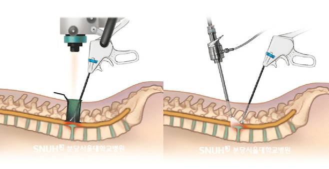 현미경 디스크 절제술(MD·왼쪽)과 양방향 내시경 디스크 절제술(BED·오른쪽).&nbsp;분당서울대병원 제공&nbsp;