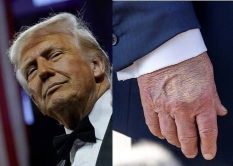 도널드 트럼프(왼쪽) 미국 대통령이 건강 검진 결과 만성 정맥부전이라는 진단을 받았다고 백악관이 17일(현지시간) 밝혔다. 오른쪽은 15일 미 메릴랜드 주 앤드루스 합동 기지에서 포착된 도널드 트럼프 대통령의 손. 로이터 연합뉴스 자료사진