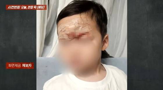 한 키즈카페에서 놀이기구에 노출된 철심에 얼굴을 다친 3살 아이의 모습. 〈사진=JTBC '사건반장'〉