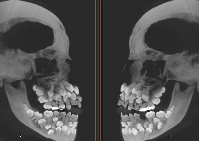 브라질의 한 소녀 입 안에서 치아 81개가 발견됐다. 사진=미국 치과교정·악안면외과학회지