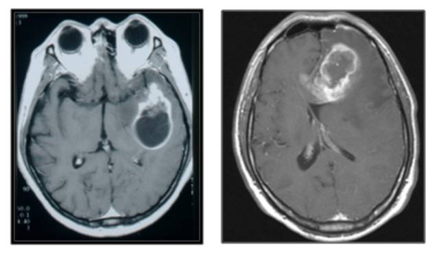 악성 뇌종양 MRI 사진. 서울대병원 제공.
