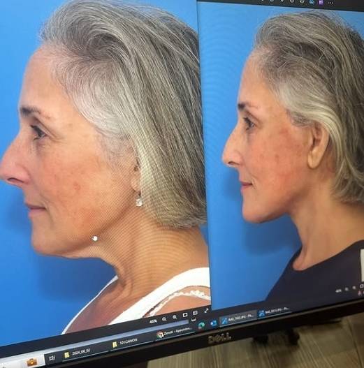 리키 레이크 소셜 미디어