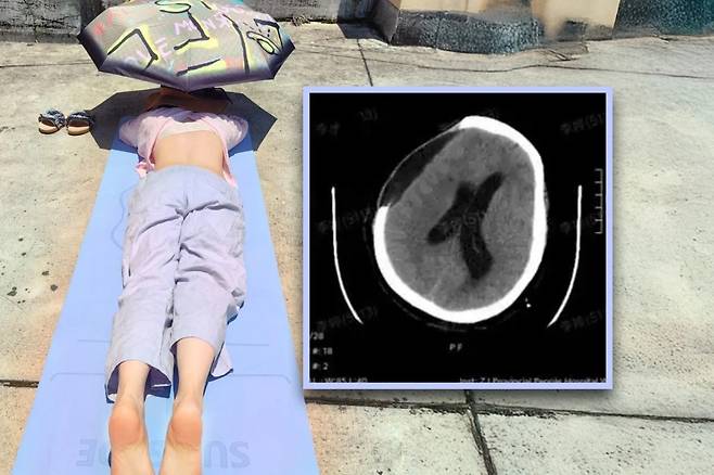 중국 저장성에서 67세 여성이 일광욕을 2시간 동안 즐기다 뇌출혈을 일으켜 심각한 뇌손상을 입었다. [smcp 갈무리]