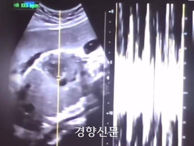 산모 권모씨의 유튜브 동영상에서 캡쳐한 초음파 사진과 심박 그래프. 서울중앙지검 제공.