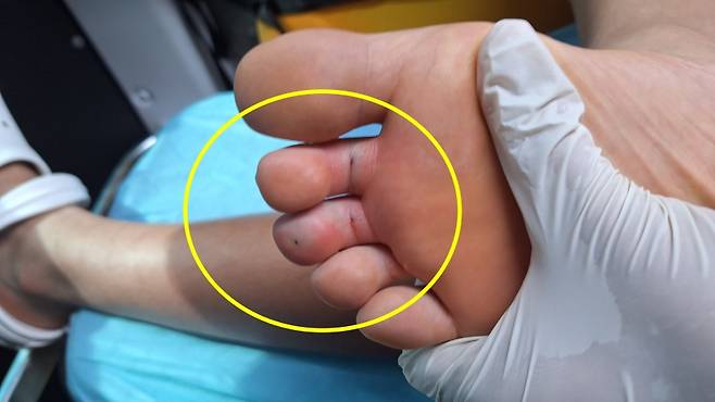 어제(23일) 오후 제주시 애월읍 고내포구에서 수영을 하다 성게로 추정되는 물체에 찔린 10대 A 군의 발가락 (제주소방안전본부 제공)