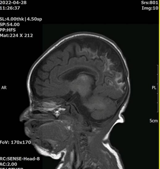 사고 발생 약 2주 뒤 찍은 민서의 뇌 MRI 사진. 사진을 감정한 의사는 ″혈류 공급이 중단되면 쉽게 손상을 받는 부위인 두정후두엽 경계 부분이 손상됐다″며 ″뇌손상의 정도는 대뇌피질이 거의 소실된 것으로 판단된다″고 했다. 사진 최씨