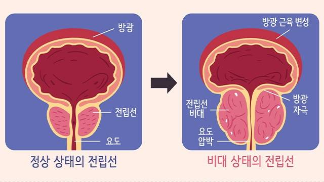 전립선 비대증은 소변 관련 증상을 유발하는 대표적인 질환 중 하나다｜출처: 게티이미지뱅크
