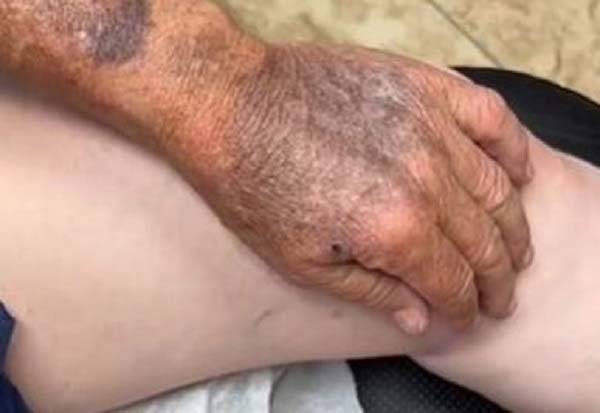 70년간 자외선 차단제를 바르지 않고 야외에서 일한 남성의 손 모습 [틱톡 갈무리]