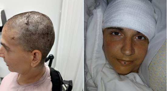 칩 이식 후 모습. (사진=X(옛 트위터) 갈무리)