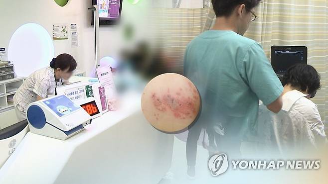 헤르페스 바이러스(HSV)에 의한 대상포진(CG) [연합뉴스TV 제공. 재판매 및 DB 금지]