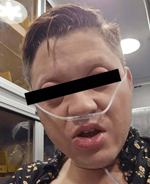 생선 대구 알레르기로 얼굴과 눈 등이 퉁퉁 부어오른 미국 30대 남성의 모습./사진=큐레우스