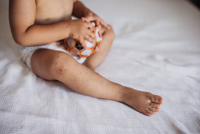 영유아의 손과 발, 입안에 물집이 생기는 수족구병 환자가 크게 증가하고 있다. 사진은 기사의 특정 사실과 관련 없음. 게티이미지뱅크