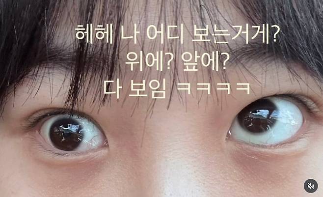 A씨가 공개한 수술 직후 사진. /인스타그램