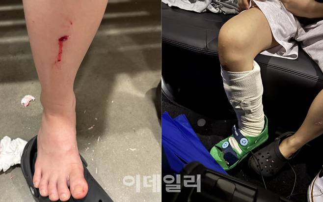 이케아 고양점 복도에 고인 물에 미끄러져 다리를 다친 10살 여자 아이의 상태.(사진=보호자 제공)