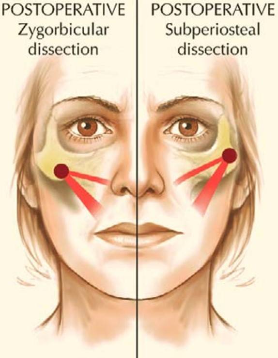 안면거상 시 광대근(빨간색)의 위치는 낮게 유지된다(왼쪽). 골막하거상시 광대근의 위치는 위로 올라간다(오른쪽).