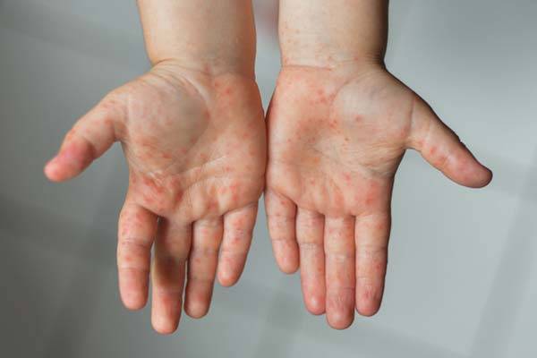아이의 손과 발, 입 주위 혹은 입안에 수포성 발진이 일어난다면 수족구병을 의심할 수 있다./사진=게티이미지뱅크