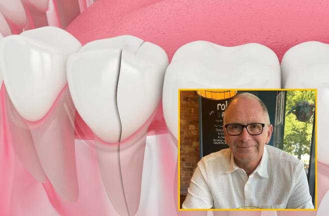 깨진 치아를 통해 세균이 뇌까지 퍼져 뇌에 고름이 차는 뇌농양을 겪은 한 50대 남성의 사연이 공유됐다. *치아 금 이미지는 이해를 돕기 위함 [사진=게티이미지뱅크/하단=SNS]