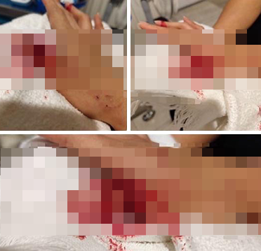 이 사고로 여성은 손가락 힘줄이 끊어지는 중상을 입었다. 페이스북 Pat Patcharaluk 캡처