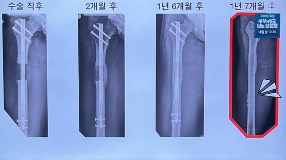 사지연장술 수술 후 경과. [사진=SBS]