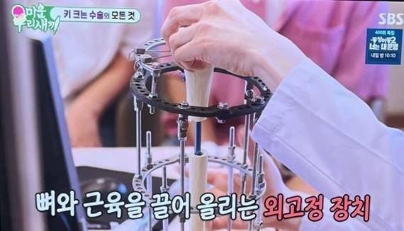 사지연장술은 뼈를 잘라 인위적으로 늘리는 수술이다. [사진=SBS]
