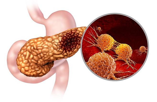 췌장암 모식도./서울대학교병원