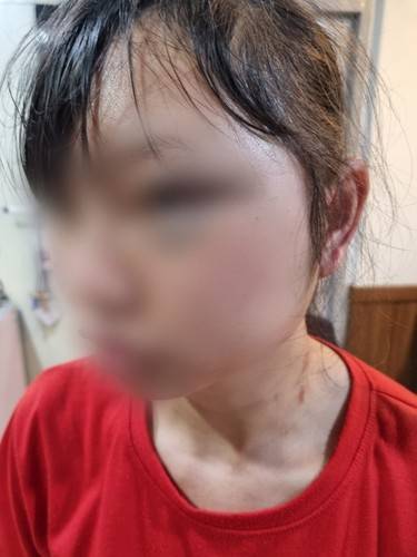 경기 용인시 한 업체에서 함께 일하던 40대 남성 A씨에게 폭행당한 이주노동자 B씨. 연합뉴스