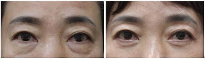애교살을 보존하는 하안검성형술 전과 후의 모습