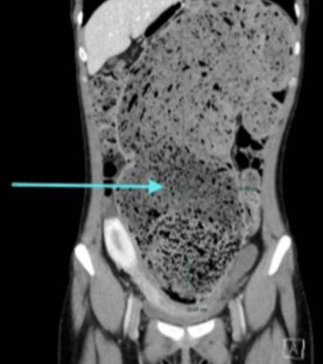 [뉴시스] 만성변비를 방치하다가 장이 비정상적으로 늘어나 굳은 대변을 직접 제거하는 수동 박리술을 받은 한 미국 여성의 사연이 알려졌다. (사진 = 더선 캡처) 2025.08.11.  *재판매 및 DB 금지