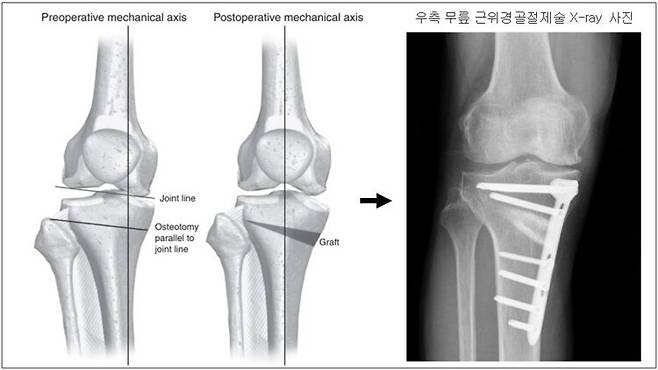 S Battaglia. HTO surgery. In Surgical techniques in TKA and alternative procedures 2015
