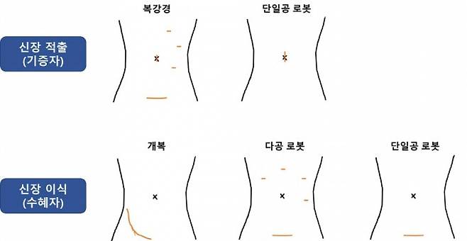 수술 방법에 따른 기증자(신장 적출) 및 수혜자(신장이식)의 절개 위치 비교. 단일공 로봇 수술을 할 땐 기증자(배꼽 3~4cm)와 수혜자(하복부 6cm)에게 하나의 절개만 낸다. 서울대병원 제공.