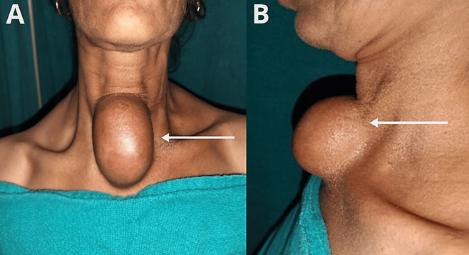 기관지성 낭종 진단을 받은 인도 30대 여성의 모습 /사진=국제 학술지 '큐레우스' 갈무리