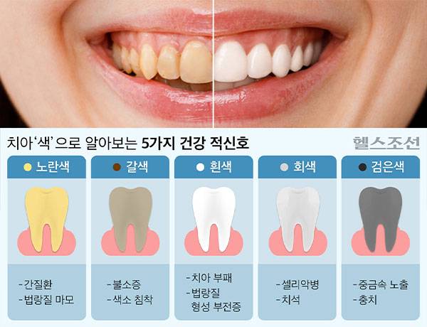 변색한 치아는 단순한 미용 문제가 아니라 전신 질환의 신호일 수 있어 주의가 필요하다./그래픽=김민선