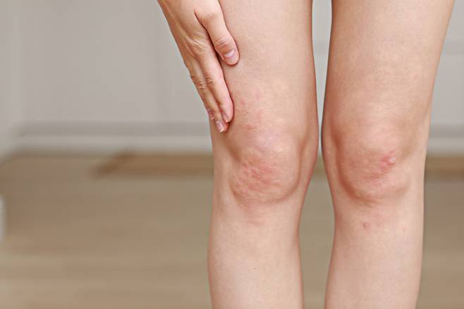 만성 두드러기 치료 및 관리법이 주목된다. 사진은 기사 내용과는 무관함. /사진=클립아트코리아