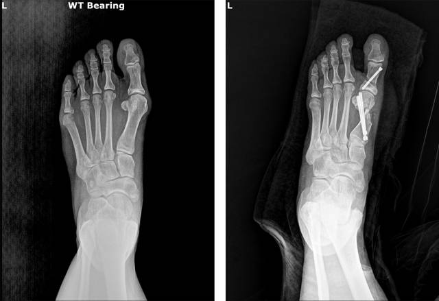 무지외반증 수술 전(왼쪽)과 수술 후(오른쪽) 엑스레이 사진. MS재건병원 제공.