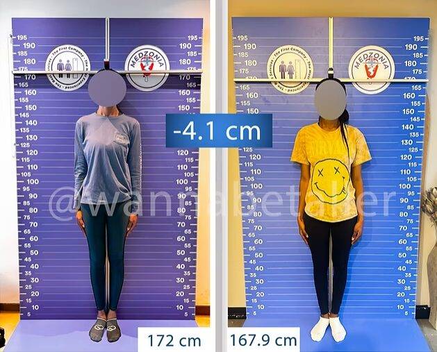 다리 뼈를 절단해 키를 줄이는 수술을 받기 위해 터키를 찾는 여성들이 늘고 있다. [사진=Height Reduction Clinic]