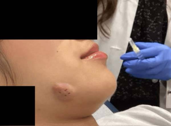 사랑니 발치 후 방선균증이 생기면서 볼에 딱딱한 결절이 생긴 18세 여성의 모습./사진=큐레우스