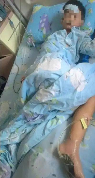 [뉴시스] 소년이 해변에서 죽은 물고기를 밟아 지느러미에 찔린 뒤, 비브리오 패혈증에 감염되는 일이 발생했다.(사진=광명망).2025.09.01 *재판매 및 DB 금지