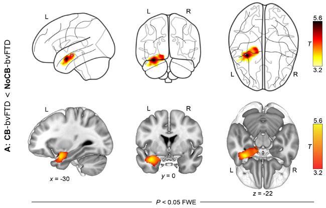 범죄 행위를 보이는 사람들은 측두엽의 위축이 더 컸다.  MPI CBS 제공.