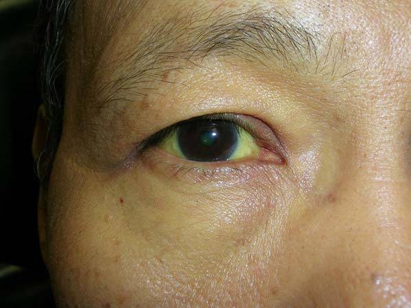 황달은 암의 신호로 알려졌지만, 결막모반증이나 카로틴 피부증, 길버트 증후군이 원인일 수도 있다./사진=클립아트코리아