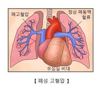 폐성 코혈압 [서울아산병원 제공]