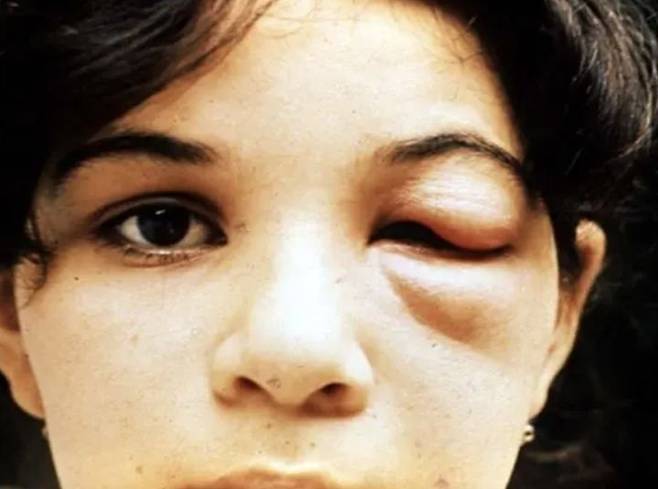 [서울=뉴시스] 미국 32개 주서 '키싱 버그'를 매개로 한 샤가스병이 확산하고 있다. 증상 중 하나인 눈꺼풀 부종이 일어난 모습. (사진 = WHO) 2025.09.07. *재판매 및 DB 금지