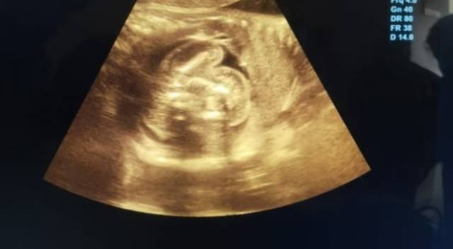 인도에서 생후 20일 된 신생아의 뱃속에서 두 개의 태아가 발견됐다. 인디아투데이