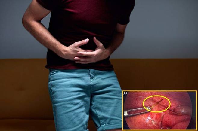 사우디아라비아에서 29세 남성이 입에 이쑤시개를 문 채 잠들었다가 삼켜 장 천공을 일으킨 사례가 보고됐다. [배경사진=게티이미지뱅크 / 우측 하단 사진=Journal of Surgical Case Reports]