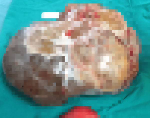 여성의 배에서 나온 25cm x 18cm x 16cm 크기의 거대 경계성 난소 종양./사진=큐레우스