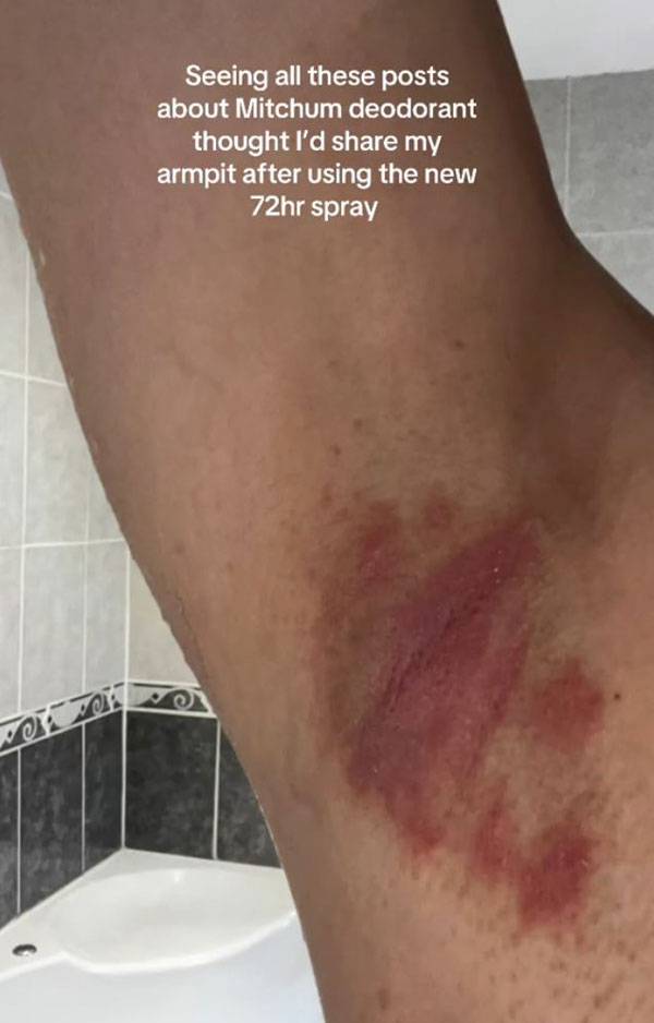 최근 데오도란트를 사용한 뒤 겨드랑이가 따끔거리고 붉어지는 등 피부 이상 반응을 호소하는 영상이 화제다./사진=틱톡 캡처