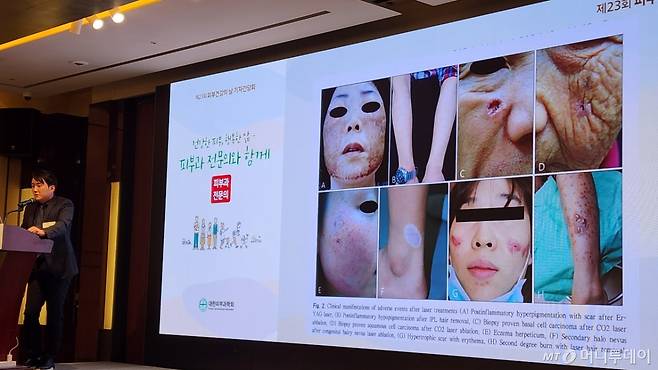 이날 기자간담회에서 안인수 피부과의사회 홍보이사가 일반의의 잘못된 시술 사례를 언급하고 있다. 피부암을 점으로 오인해 레이저로 지졌다가 피부암이 커진 사례가 공개됐다. /사진=정심교 기자